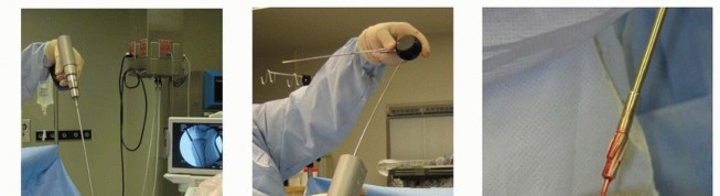 Illustration 36 for Optimizing Intramedullary Nailing for Tibial Shaft Fractures