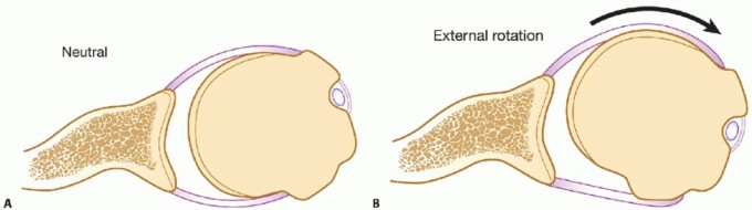 Illustration 4 for Latarjet for Instability: Bone Loss Solutions, Per Burkhart SS, Lo