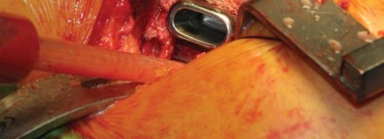 Illustration 39 for Kinectiv® Stem: Modular Necks for Primary THA Success