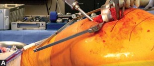 Illustration 33 for Exploring the Ambulatory Surgical Setting for Total Hip Replacement