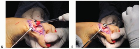 Illustration 47 for End Articular Cartilage Loss: Arthrosurface HemiCAP Resurfacing