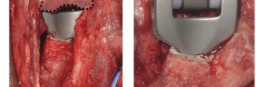 Illustration 39 for Distal Humeral Fractures: When Is Elbow Replacement the Best Option?