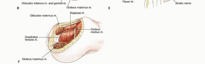 Illustration 18 for Mastering Hip Disarticulation: Through the Hip Joint Capsule