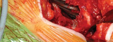 Illustration 15 for S-ROM: Inside the Technique of Modular Implant Design