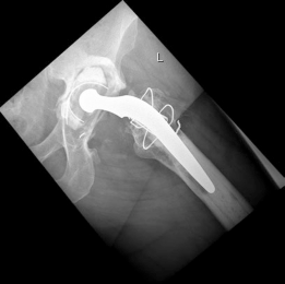 Illustration 3 for Revision THA: Unlocking Stability with Porous Tantalum Cups