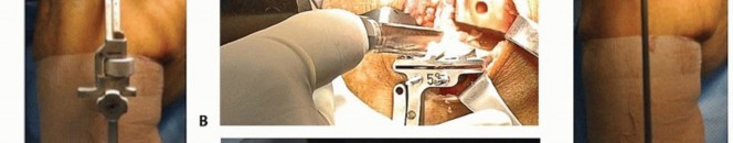 صورة طبية: استبدال مفصل الركبة الجزئي: حل متقدم لآلام الركبة المستمرة مع الأستاذ الدكتور محمد هطيف