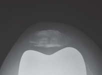 Illustration 72 for Mastering Gap Balancing in Revision TKA: Avoid Common Pitfalls