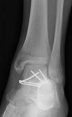 Illustration 123 for OrthoCash: Trauma MCQs & Cases for a yearold woman