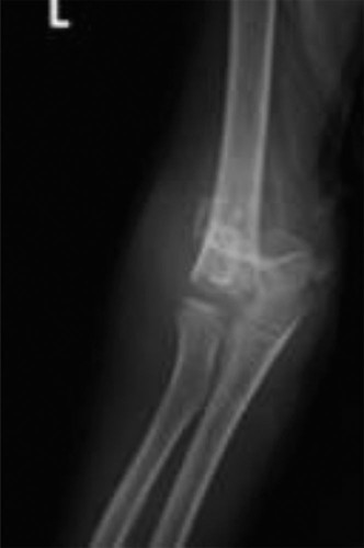 Pediatric Supracondylar Humerus Fractures: Case & Management