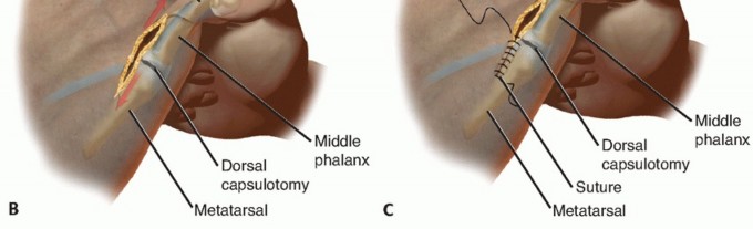 Illustration 27 for Toe Deformity Pain? Rebalance Flexor to Extensor for Relief