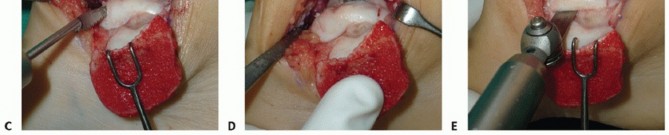 Illustration 11 for Unlock Healing: Medial Malleolar Osteotomy for Talus OLT Allografts