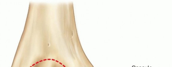 Medial Epicondyle Fracture Repair: Resolve Medial Elbow Instability