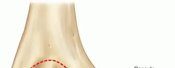 صورة توضيحية لـ كسر اللقيمة الإنسية للمرفق: دليل شامل للعلاج والتعافي بفضل خبراء اليمن