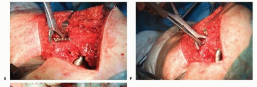 Illustration 33 for Special THA Techniques for Severe Deformities Around the Hip