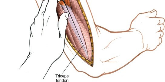 Illustration 39 for Mastering the Approach to the Distal Humerus: Safety & Skills