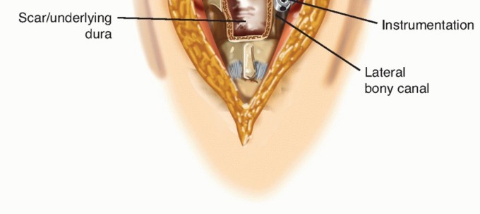 Illustration 6 for Revision Lumbar Surgery: When Failed Back Syndrome Requires Reoperation