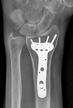 صورة طبية: دليل الأستاذ الدكتور محمد هطيف الشامل لأمراض وإصابات اليد والمعصم في صنعاء