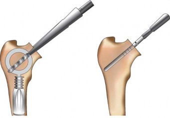 Illustration 31 for The Silent Hip: Achieving a Truly Silent, Pain-Free Joint