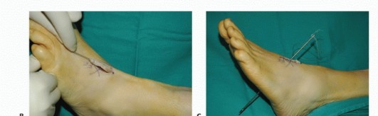 Illustration 35 for Foot Drop Surgery: How a Pin or Drill Elevates Tendon Transfer