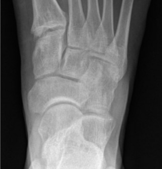 Illustration 4 for Medial and Lateral Foot Pain: Diagnosis & Imaging Insights