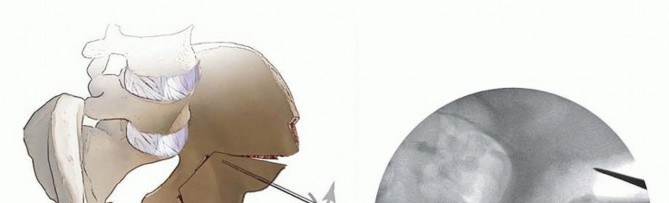 Illustration 23 for Restore Hip Health: Pelvic Osteotomy for Acetabular Dysplasia & CEA of Less