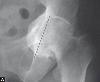 Illustration 33 for Optimizing Acetabular Component Cementation for Superior Outcomes