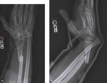 Radial Shaft Fracture: Spotting & Managing DRUJ Instability