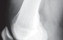 صورة توضيحية لـ جراحة استبدال مفصل الركبة الجزئي (UKA): تجنب الأخطاء والاستفادة القصوى في صنعاء مع الأستاذ الدكتور محمد هطيف