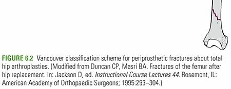 Illustration 5 for Periprosthetic Fractures: Causes, Risks, & Effective Treatment