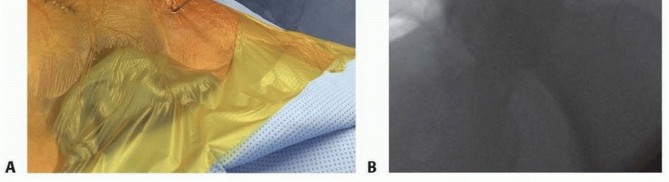 Illustration 34 for Emergency Fixation of the Pelvis: Control Bleeding & Restore Stability