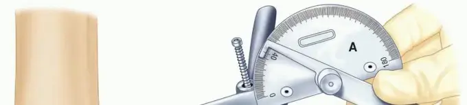 صورة توضيحية لـ تثبيت مفصل الكوع: حل دائم للألم الشديد واستعادة الاستقرار بفضل خبرة الأستاذ الدكتور محمد هطيف