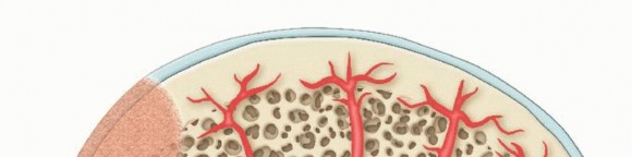Illustration 8 for Dissecans of the Knee: What's the Difference – OCD vs. AVN?