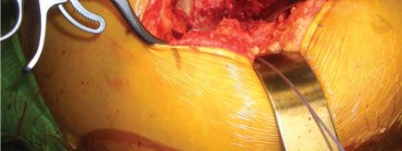 Illustration 86 for Successful Total Hip Replacement in Developmental Dysplasia