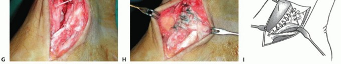 Illustration 31 for Medial Ankle Instability: Find Relief with Reconstruction