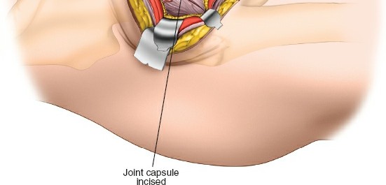 Illustration 92 for Unlocking Every Aspect of the Hip's Surgical Approaches