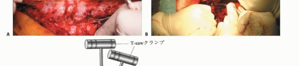 Illustration 17 for Total En Bloc Spondylectomy: Complete Resection for Spinal Tumors