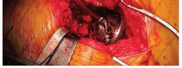 Illustration 29 for Uncemented Acetabular Revision: Optimizing Hemispherical Cup Use