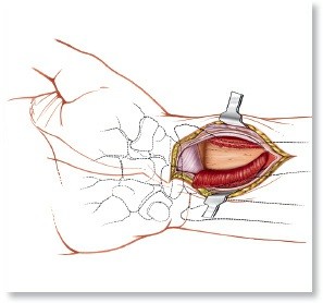 Essential Surgical Approaches: Uncover Every Aspect of the Wrist
