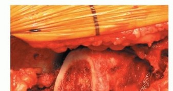 صورة طبية: استبدال مفصل الورك بدون أسمنت: استعادة الحركة والثبات في صنعاء مع الأستاذ الدكتور محمد هطيف