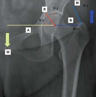 Mastering Soft Tissue Balancing for Optimal THR Outcomes