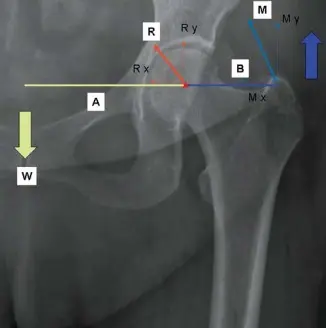 إتقان توازن الأنسجة الرخوة لمفصل ورك صناعي مثالي: دليل شامل للمرضى مع الأستاذ الدكتور محمد هطيف