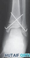 Illustration 18 for Pediatric Ankle Fractures: Management to Prevent Long-Term Issues