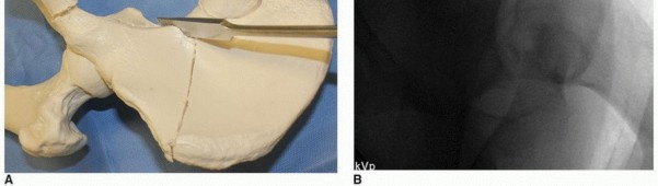 صورة توضيحية لـ جراحة قطع العظم حول الحُق وقطع عظم الفخذ: إعادة محاذاة مفصل الورك لراحة دائمة مع الأستاذ الدكتور محمد هطيف