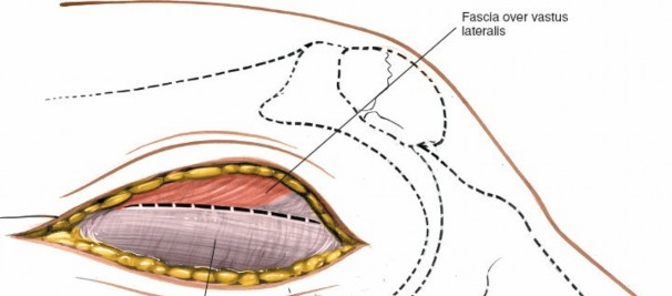 Illustration 223 for Mastering Knee Approaches: Spotlight on Superficial Medial Ligament