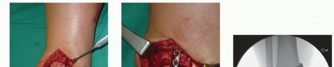 Illustration 20 for Unlock Healing: Medial Malleolar Osteotomy for Talus OLT Allografts