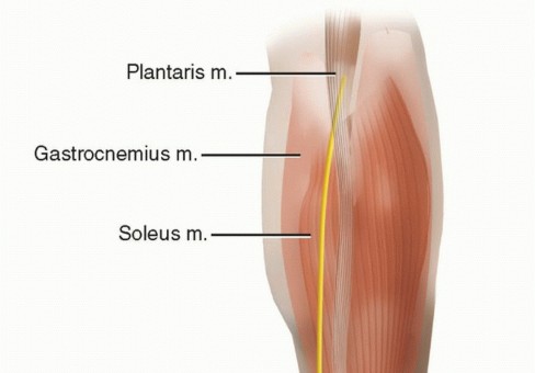 Percutaneous Versus Open Achilles Repair: What's the Difference?
