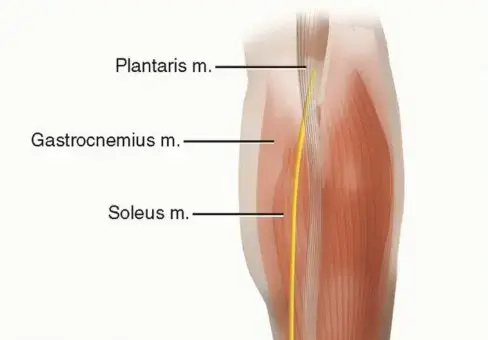 تمزق وتر أخيل: دليل شامل للعلاج والتعافي مع الأستاذ الدكتور محمد هطيف في اليمن