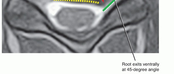 Illustration 2 for How ACDF Clears Your Posterior Disc Space for Lasting Relief