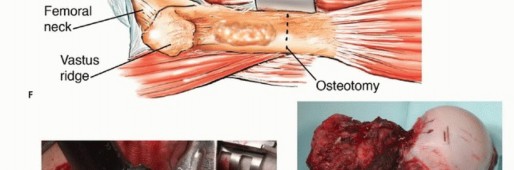 Illustration 17 for Mastering Femoral Metastases: Optimal Function for Femoris & Vastus