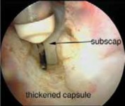 Illustration 20 for Capsular Releases for Loss of Motion: Restore Your Shoulder